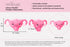 nerdbugs Uterus Plush Funny Hysterectomy Gift, Endometriosis & Fertility Support Toy, Gynecology Gift for Womens