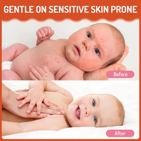 100ml/3.38oz Baby Eczema Cream for Kids, Eczema Therapy & Relief Body Lotion - Nourishing Skin Protectant, Soothes Dry