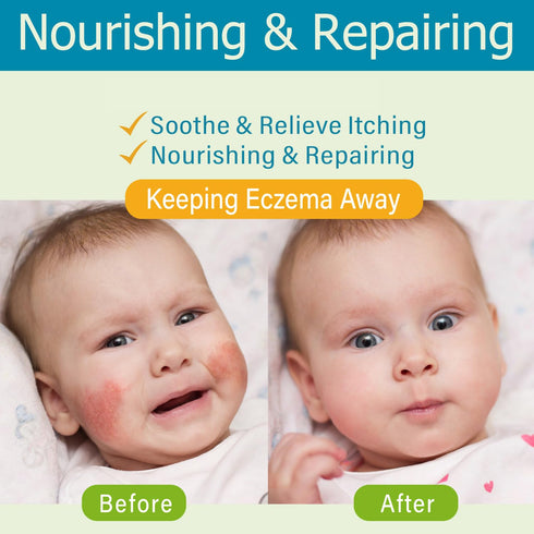 (100ml, Oz, 3.38) AOAO Baby Eczema Cream - Kids Eczema Therapy & Relief Body Cream, Nourishing Skin Protectant Soothes