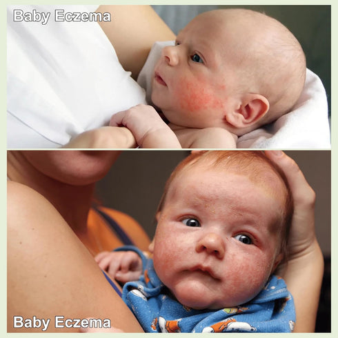 (100ml, Oz, 3.38) AOAO Baby Eczema Cream - Kids Eczema Therapy & Relief Body Cream, Nourishing Skin Protectant Soothes