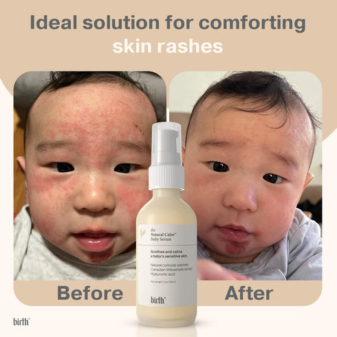 Baby Eczema Serum for Newborns, Steroid-Free, Safe for Rashes and Redness - Made in Canada, 20z | 59 ml