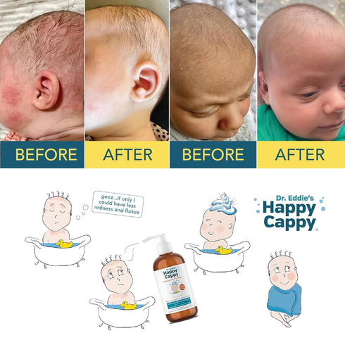 8 oz Happy Cappy Cradle Cap Medicated Shampoo and Body Wash with Comb - Baby Dandruff Shampoo, Helps Infants