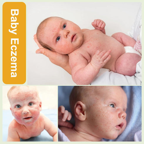 (100ml, Oz, 3.38) AOAO Baby Eczema Cream - Kids Eczema Therapy & Relief Body Cream, Nourishing Skin Protectant Soothes