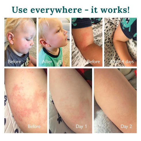 Baby and Kids Moisturizing Cream for Sensitive Skin, Multi-Purpose Healing Therapy for Eczema, Psoriasis, Rash