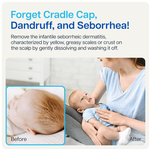 NAVEH PHARMA Cradle Cap Cleanser for Baby & Kids | 100% Natural Treatment, Spray & Wash, 1 FL OZ