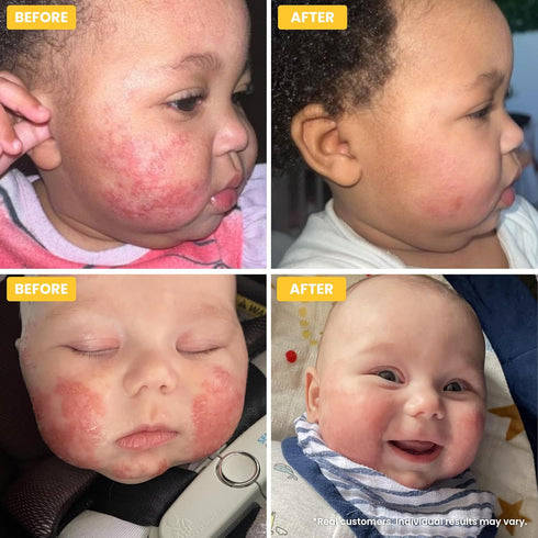 Newborn-12 (75g) Grahams Natural Baby Eczema Cream Moisturizer for Years | Rash, Redness, Dry Skin & Itch Relief |